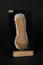 Pityriasis rubra pilaire. On remarquera l'exagération des plis cutanés, la teinte rouge uniforme app [...]