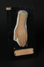 Pityriasis rubra pilaire (maladie de Devergie). On remarquera la teinte rouge générale dissimulée pa [...]