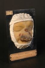 Syphilide pustulo-crustacée du nez