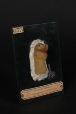 Chancre syphilitique du gland, simulant un épithéliome