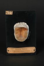 Lupus tuberculeux de la voûte palatine. Homme âgé de 30 ans, officier