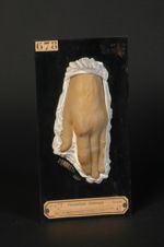 Dactylite syphilitique tertiaire de l'index gauche