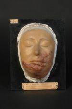 Lupus ulcéreux végétant de la joue et du menton (V. le n° 872, même malade deux ans plus tard, après [...]