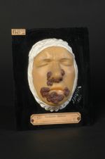 Syphilide pustulo-crustacée de la face