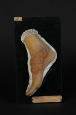 Lupus végétant multiple. Lupus végétant du pied, lésion en activité. Homme âgé de 20 ans