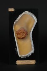 Lupus végétant multiple. Lupus végétant du genou, lésion en activité. Homme âgé de 20 ans