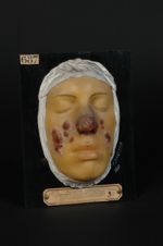 Lupus végétant multiple. Lupus végétant de la face. Homme âgé de 20 ans