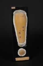 Lichen plan du cuir chevelu ; lichen corné de la jambe