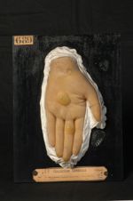 Gale bulleuse, pemphigoïde