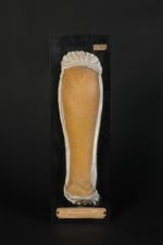 Erythème copahique de l'avant-bras, à forme papuleuse et figurée. (Moulage très décoloré, Inv. 1922)