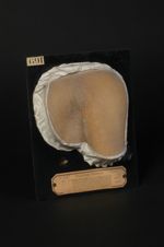 Pityriasis rubra pilaire ; maladie de Devergie. Sur la teinte insuffisamment rendue du fond, on rema [...]