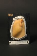 Anomalie congénitale de l'oreille gauche. Absence du méat auditif. Pavillon rudimentaire. Surdité un [...]