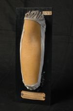 Trichophytie cutanée probable (Inv. 1922). Diagnostic indéterminé, érythème papuleux circiné avec sp [...]