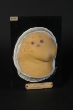 Syphilide papulo-vésiculeuse, syphilide vacciniforme, de la région mammaire