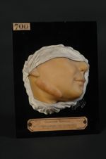 Chéloïdes cicatricielles ; cicatrices vicieuses hypertrophiques, après traitement chimique du lupus. [...]