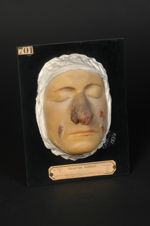 Lupus ulcéreux végétant de la face. Homme âgé de 20 ans (V. le n° 793, même malade quelques mois plu [...]