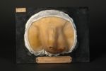 Syphilis gommeuse du testicule, fongus bénin (Inv. 1922). Sarcocèle gommeux, variété de fongus bénin