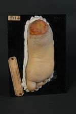 Épithéliome ulcéré du talon