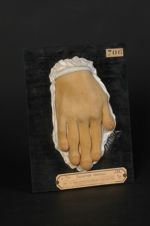 Doigts en massue, chez un sujet ayant succombé à une entérite tuberculeuse, sans lésions pulmonaires