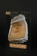 Plaques syphilitiques (Inv. 1922). Syphilides papulo-érosives végétantes de l'aisselle