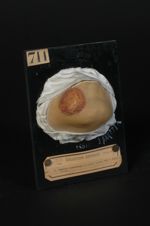 Chancre syphilitique du menton