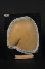 Syphilide érythémateuse ; roséole syphilitique (moulage très décoloré, Inv. 1022). Femme âgée de 29  [...]