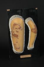 Syphilide pustulo-crustacée, verruqueuse et végétante, du membre supérieur et de la cuisse, chez une [...]