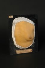 Syphilide acnéiforme du thorax