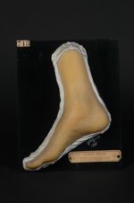 Lupus végétant du pied ; guérison presque complète. Homme âgé de 20 ans