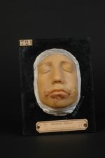 Herpès fébrile des lèvres