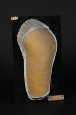 Psoriasis circiné généralisé