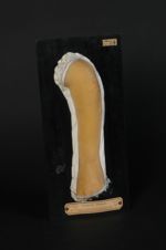 Zona de l'avant-bras gauche. Femme âgée de 24 ans