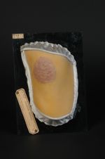 Lupus scléreux de la cuisse. Homme âgé de 49 ans