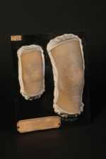 Pityriasis rubra pilaire ; maladie de Devergie. Homme âgé de 43 ans, terrassier. On voit au coude et [...]