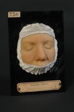 Acné rosée et pustuleuse du nez et des joues