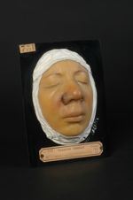 Syphilome en nappe du nez et de la lèvre supérieure, chez une femme