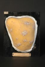 Syphilide papulo-crustacée du dos ; syphilis secondaire