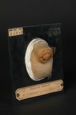 Syphilide ulcéreuse chancriforme du prépuce