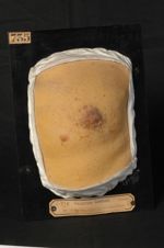 Gale ; eczéma symptomatique de la région mammaire