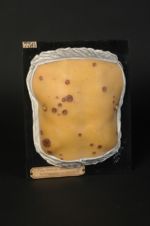 Plaques syphilitiques (Inv. 1922). Syphilides pustulo-crustacées