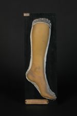 Prurit des ictériques. Lésions produites en grande partie par le grattage ; on remarquera les divers [...]