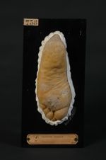 Cors de la plante du pied, limités au côté gauche