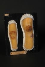 Gommes syphilitiques ulcérées