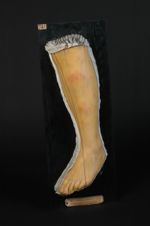 Erythème noueux (moulage décoloré, Inv. 1922)