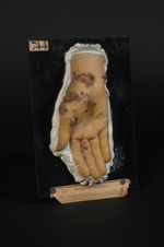 Syphilide papulo-crustacée de la main ; syphilis secondaire. Femme âgée de 23 ans, cuisinière