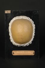 Lupus érythémateux du cuir chevelu. Femme âgée de 40 ans