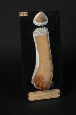 Syphilis mutilante ; épithéliomisation secondaire. Après avoir été très amendée par l'iodure de pota [...]