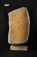 Trichophytie. Erythème vésiculeux circiné trichophytique