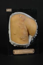 Erythème polymorphe ; érythème bulleux, pemphigoïde en plusieurs points