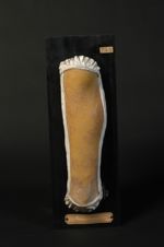 Acné cadique. Homme âgé de 23 ans